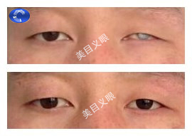 成人-眼球萎缩 佩戴效果