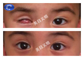 儿童-眼球摘除 佩戴效果