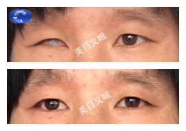 成人-眼球萎缩 佩戴效果